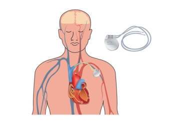 Heart pacemaker. Human heart anatomy cross section with working implantable cardioverter defibrillator.