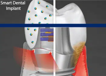 A “smart” dental implant could improve upon current devices by employing biofilm-resisting nanoparticles and a light powered by biomechanical forces to promote health of the surrounding gum tissue. (Image: Courtesy of Albert Kim, Penn’s School of Dental Medicine)