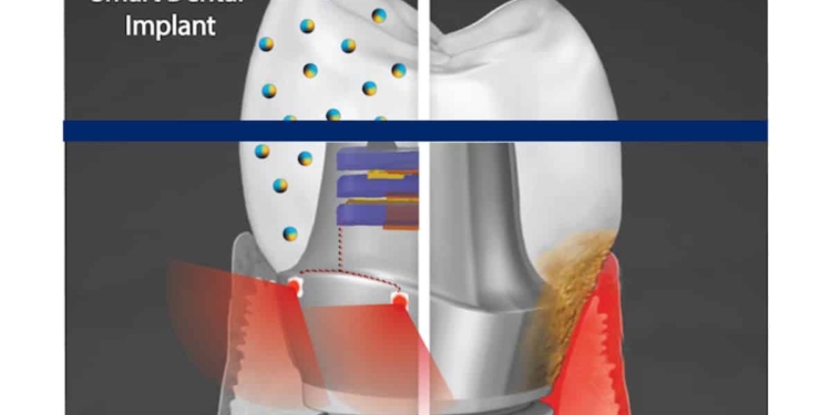 A “smart” dental implant could improve upon current devices by employing biofilm-resisting nanoparticles and a light powered by biomechanical forces to promote health of the surrounding gum tissue. (Image: Courtesy of Albert Kim, Penn’s School of Dental Medicine)