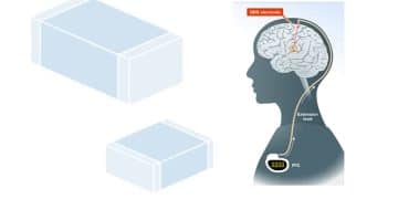 How MLCC Capacitors Support Implantable Deep Brain Stimulators